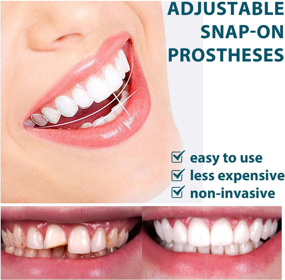 Snap On Smile Braces Teeth Kit For Men & Women
